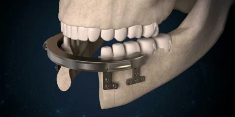 Alat rekonstruksi rahang bawah
